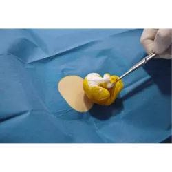 Serweta operacyjna z otworem 6 x 8 cm NOBADRAPE®